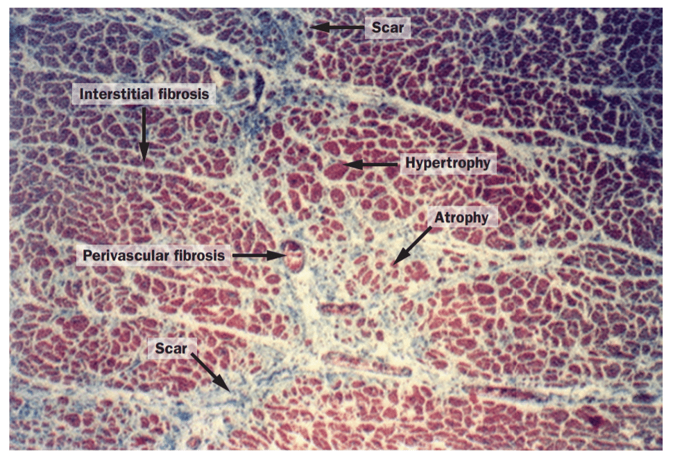 Myocardium in hypersensitive heart disease